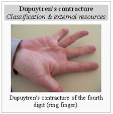 Dupuytren's Contracture | Orthotic & Prosthetic Product Reviews, Blogs ...